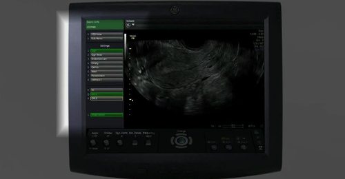 Voluson Performance Series: 3D Gynecology