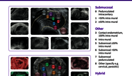 Fibroid Poster (EN)