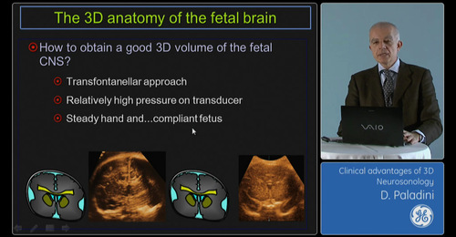 Advanced VISUS - Clinical advantages of 3D Neurosonology ...