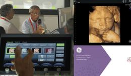 ISUOG 2017 - Secret of the Masters I Dr B Benoit & Dr R  ...