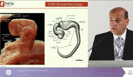 ISUOG 2017- Evaluating CNS in 2nd trimester using e4D Dr. R Ximenes 